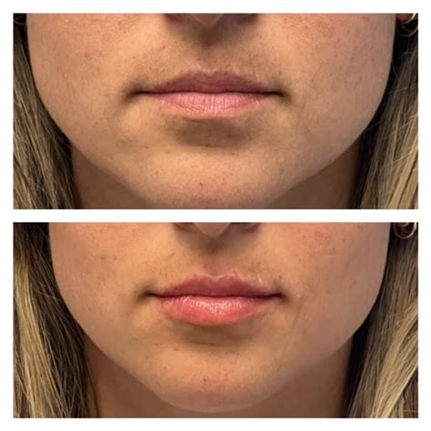 Lip Filler 1_2 syringe Juvederm Ultra - New Med Spa
