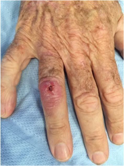 cutaneous melioidosis  updated review  primer