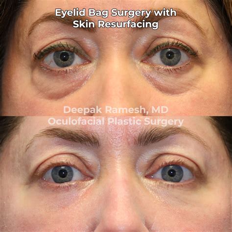 skin resurfacing   jersey center  eye facial plastic surgery