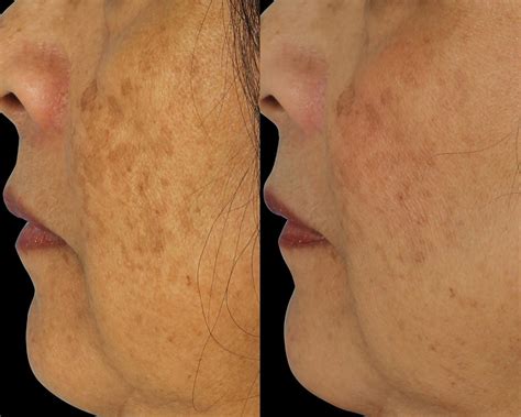 patient  hyperpigmentation    dr anil shah