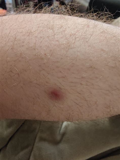 Should I be concerned about this? Bug bite seemed to bruise after a