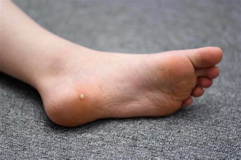 6 Ways to Get Rid of Foot Warts - Well Heeled Podiatry