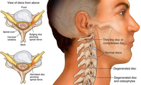 Cervical Radiculopathy - Motus Physical Therapy