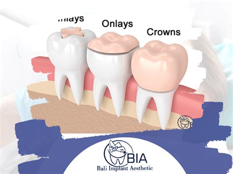 Onlay VS Dental Crown - Bali Implant Aesthetic (BIA) Dental Center