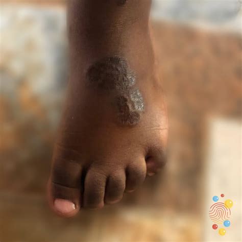 granuloma annulare  feet