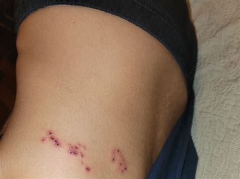 Extreme lower back pain feels like I’m being stabbed and then this rash