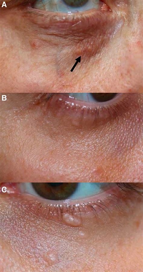 Clear Cell Syringoma of the Eyelids, a Distinctive Histopath