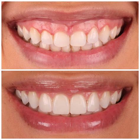 No Prep Veneers - Austin Artistic Dental | #1 Cosmetic Dentist in Austin