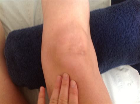 Vastus Lateralis Pain