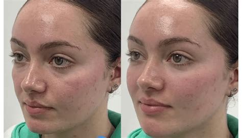surgical nose job nose fillers    results