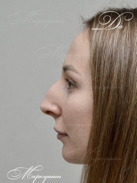 Ринопластика носа с горбинкой, 1 мес | Пластический хирург Маркушин