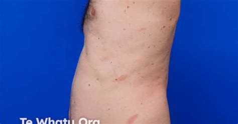 Chronic superficial scaly dermatitis image