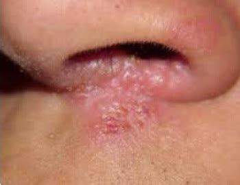 What is Nasal Vestibulitis-Boil or Pimple Inside Nose?