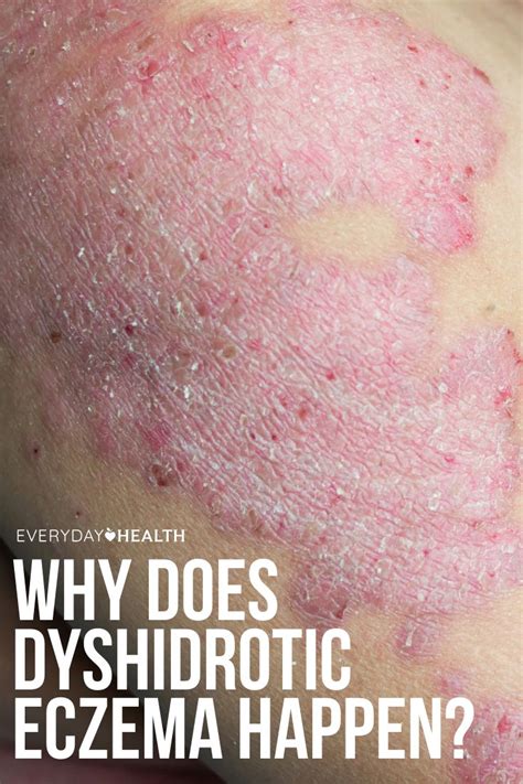 Why Does Dyshidrotic Eczema Happen? | Eczema, Eczema symptoms, Eczema diet