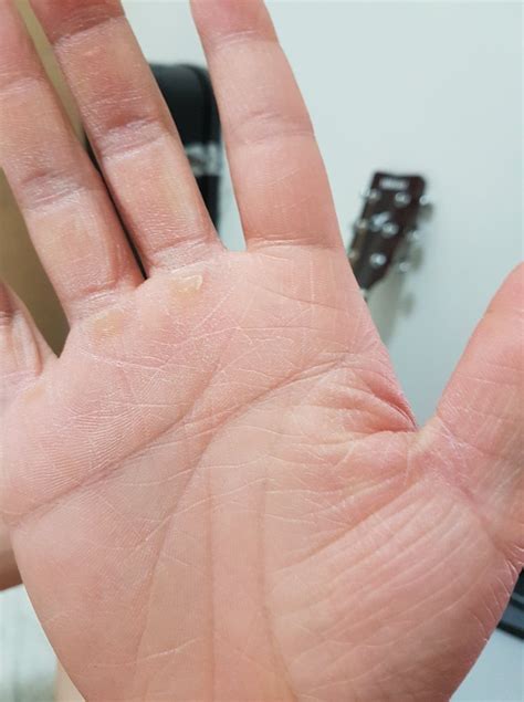 I have both hyperhidrosis and hypohidrosis and thinking about starting
