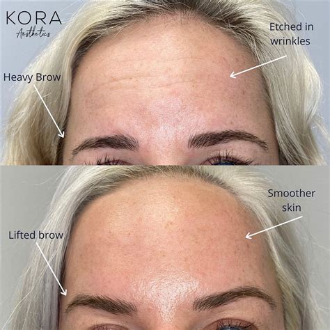 Before and After Botox Photo Gallery - Remarkable Results