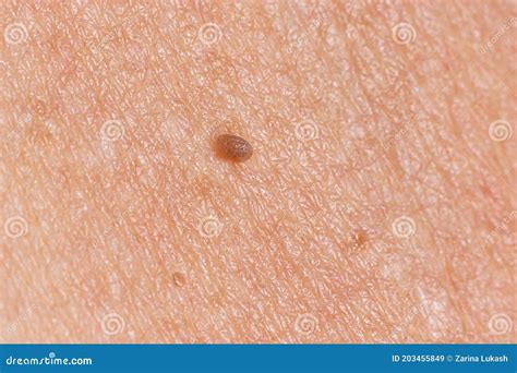 Papilloma On Human Skin - Benign Tumor In The Form Of Mole, Nevus ...