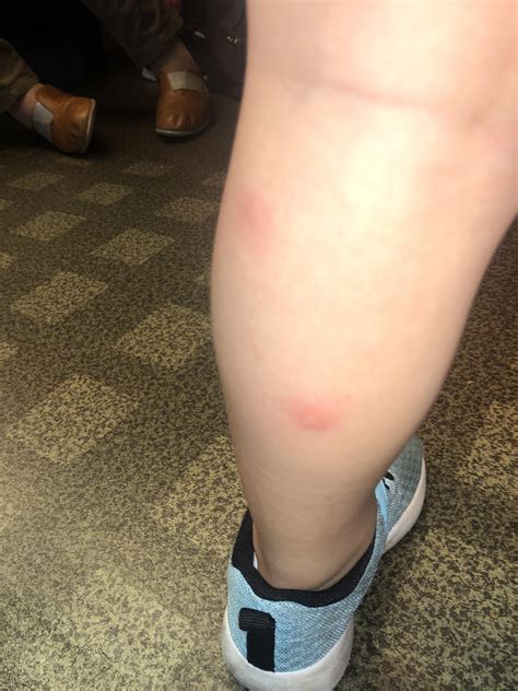 Should I be worried about these bug bites - itchy and a bit painful ...