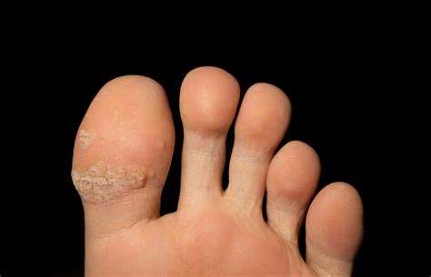 Tipos De Hongos En Los Pies
