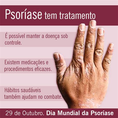 O Que Causa A Psoríase - O Que é Psoríase e Como é o Tratamento?