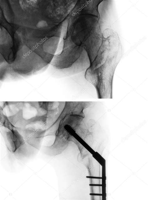 Intertrochanteric fracture femur ( thigh bone ). X-ray of hip and ...