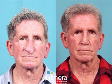 Laser Skin Resurfacing (DOT CO2) Before and After Pictures Case 873 ...