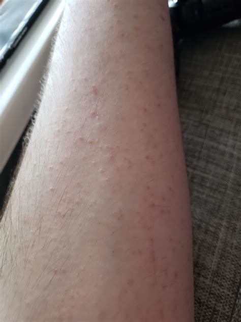 Itchy Skin Rash