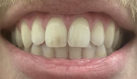 gray stains  teeth raskdentists