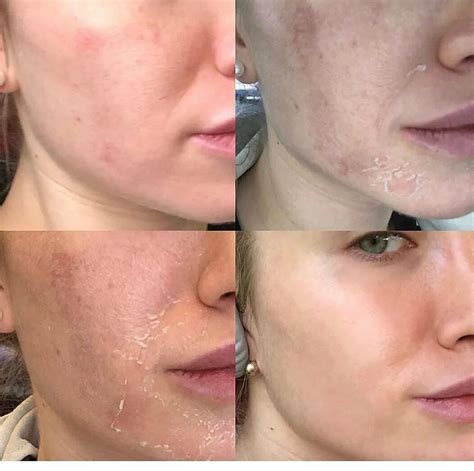 Желтый пилинг лица в домашних условиях: что это и как его провести