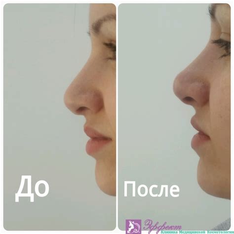 Безоперационная ринопластика носа