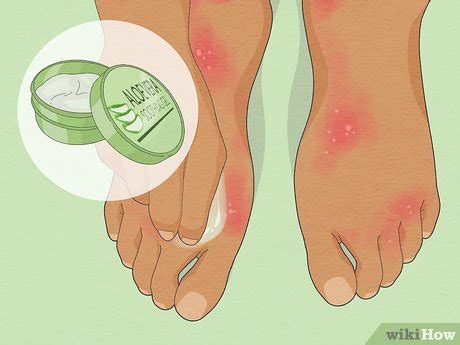 How to Treat Dyshidrotic Eczema: 8 Effective Home Remedies
