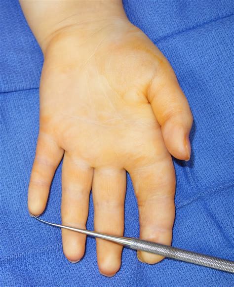 Macrodactyly/ Large digits | Congenital Hand and Arm Differences