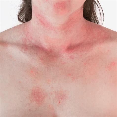 Different skin rashes that itch - comfortbooy