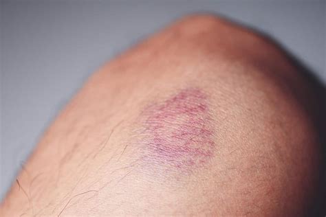 Galo Na Cabeça Termo Tecnico - Hematoma Subgaleal - O Popular "Galo" Na Cabeça - Aprenda Mais - Blog ...