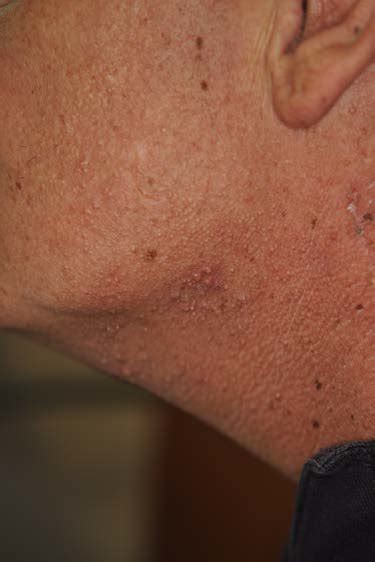 Radiation-induced acne with follicular papules with few pustules and ...