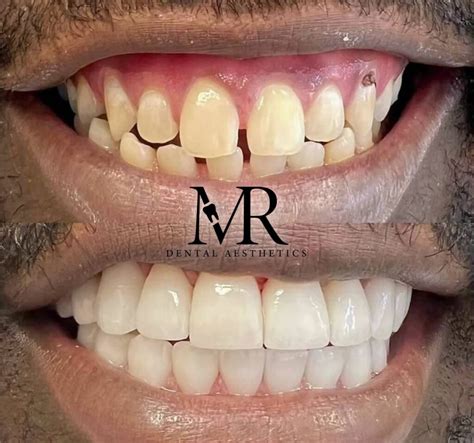 how to get rid of a gummy smile