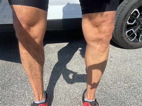 I had knee surgery and they shaved one leg. I’m not a leg shave guy