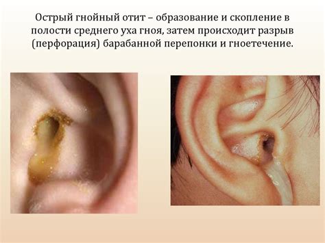 Как выглядит отит среднего уха фото