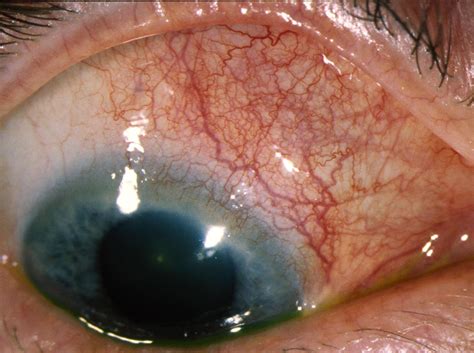 SCLERITIS