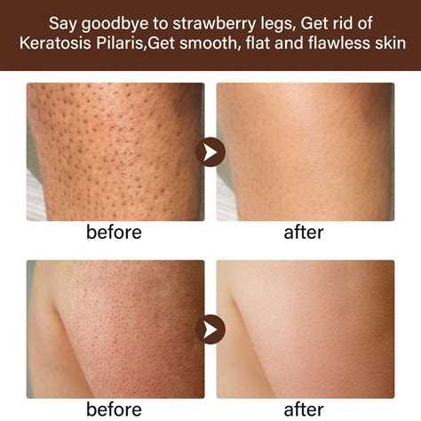 how to get rid of strawberry legs 1