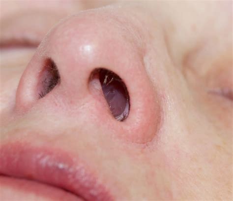 Nasal polyps: Are they causing your nose block (nasal obstruction
