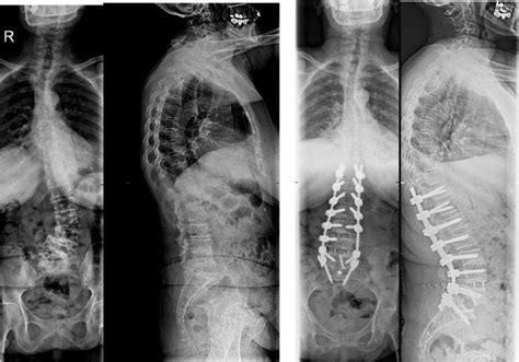 Lumbar Lordosis Correction With Interbody Hyperlordotic Cages: Initial ...