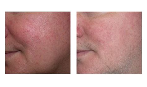 rosacea treatment clinic  dubai