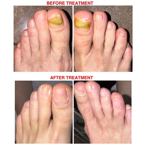 The Podology - 📍NAIL FUNGUS TREATMENT : การรักษาอาการเชื้อรา 📍BACTERIA
