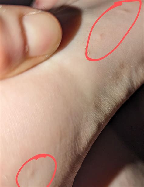 Unbearable itchy bumps, antihistamines and steroids not working. : r