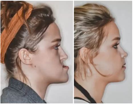 underbite    open bite jaw surgery braces