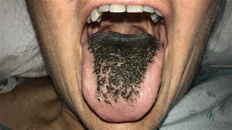 Black Hairy Tongue Hairy Tongue Condition, Treatments And Pictures For