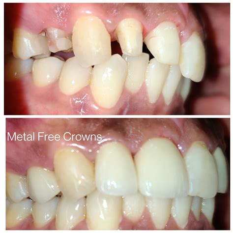 Prosthodontics - Vinsmiles Advanced Dentistry™