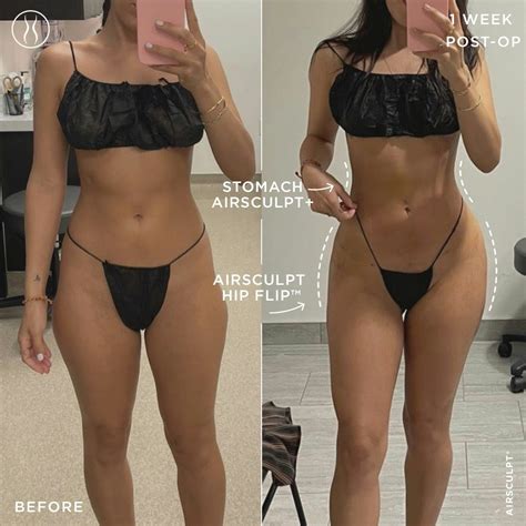 Hip Flip™ vs BBL: Which Can Fix Hip Dips? | AirSculpt