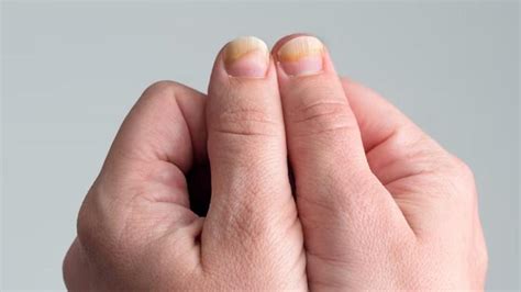 Onicolisis, cuando tus uñas dicen adiós: Uno de los efectos secundarios ...